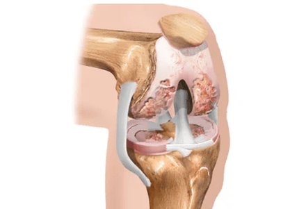 Arthrosis or arthritis of differences