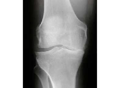 Diagnosis of knee articulation arthrosis