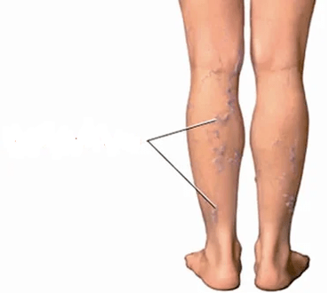 The consequences of knee arthrosis