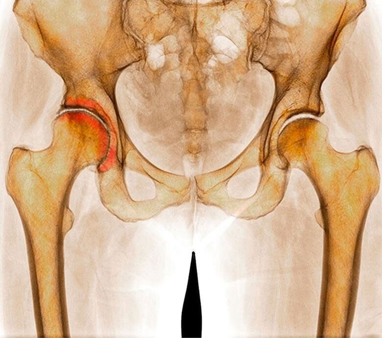 Hip Articulation Arthrosis