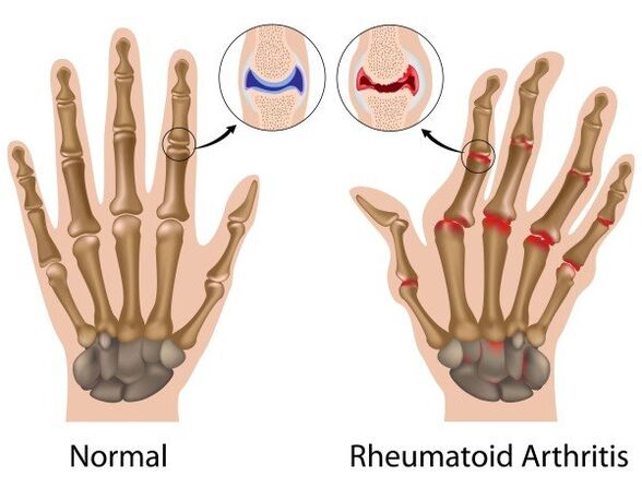 Pathology and rheumatoid arthritis articulations