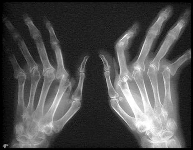 Picture x -ray of the hands affected by arthrosis
