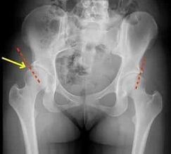 Methods for the treatment of hip joint arthrosis