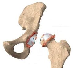 The reasons for the development of hip joint arthrosis