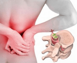 Lumbago at the beginning of osteochondrosis disease disease