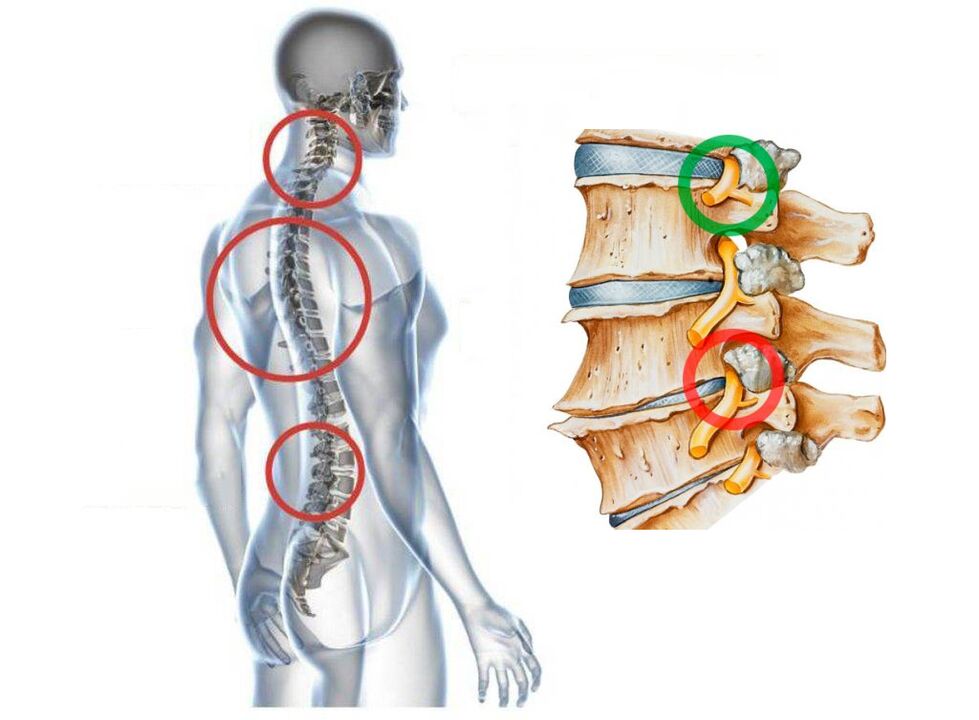How is cervical osteochondrosis of vertebrae