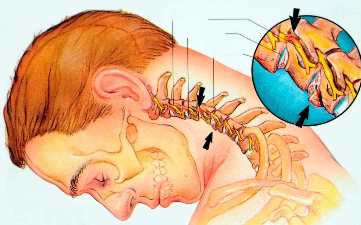 What is cervical osteochondrosis