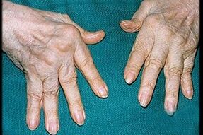 arthritis symptoms in fingers