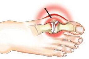 joint damage due to arthritis and osteoarthritis