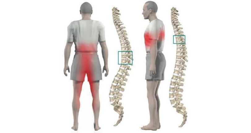 body and back pain with osteochondrosis