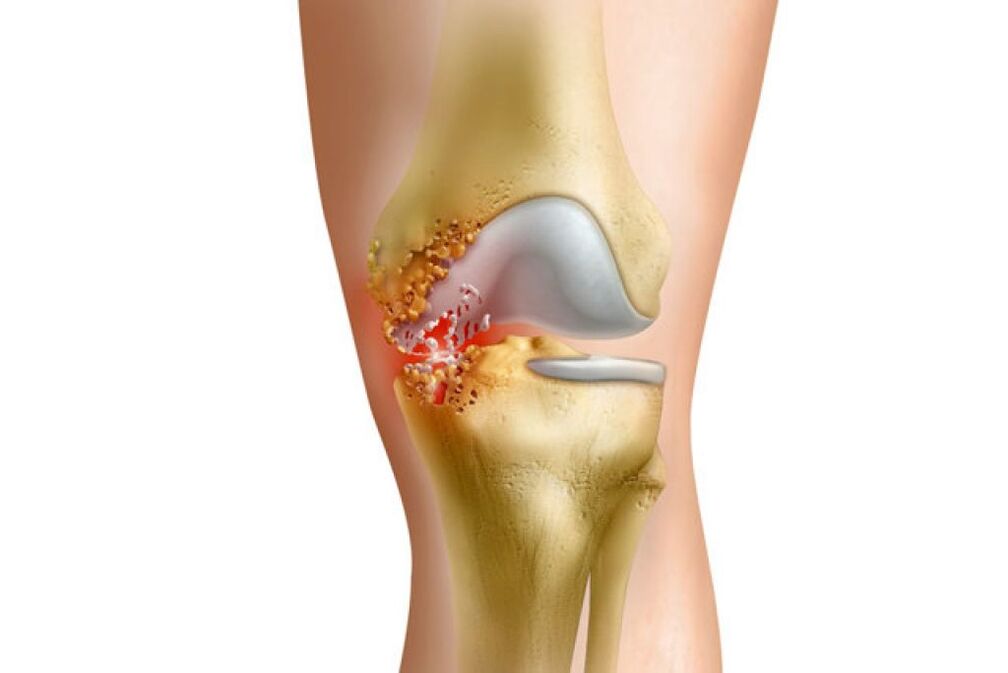 inflammation as a cause of hip joint pain