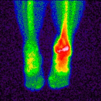 The differential diagnosis method for crusarthrosis is scintigraphy