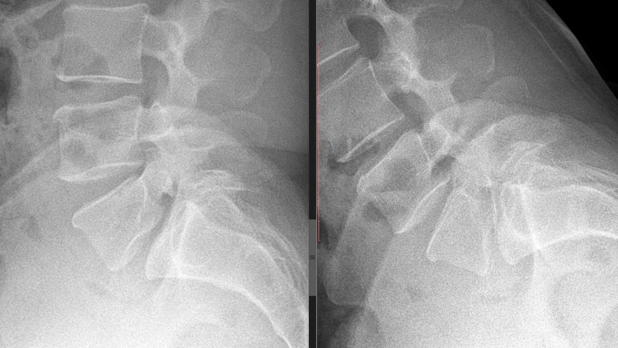 cervical spine image